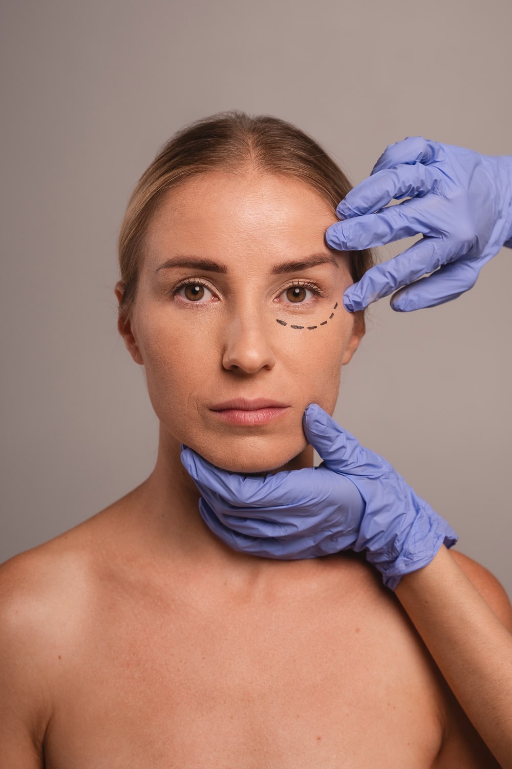 Dudas frecuentes sobre la blefaroplastia